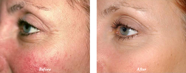 Laser Genesis Before and after photos patient 1