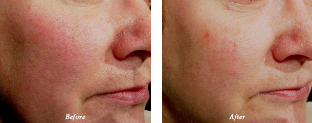 Laser Genesis Before and after photos patient 4
