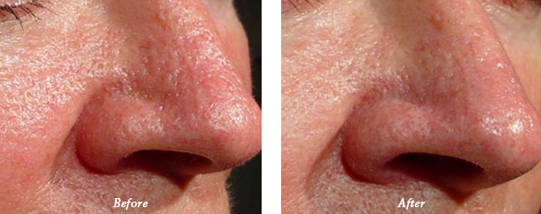 Laser Genesis Before and after photos patient 5