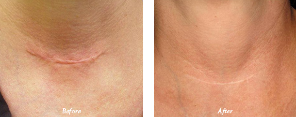 Laser Genesis Before and after photos patient 9