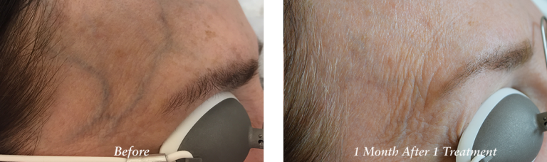 Vein Removal treatment before and after photos